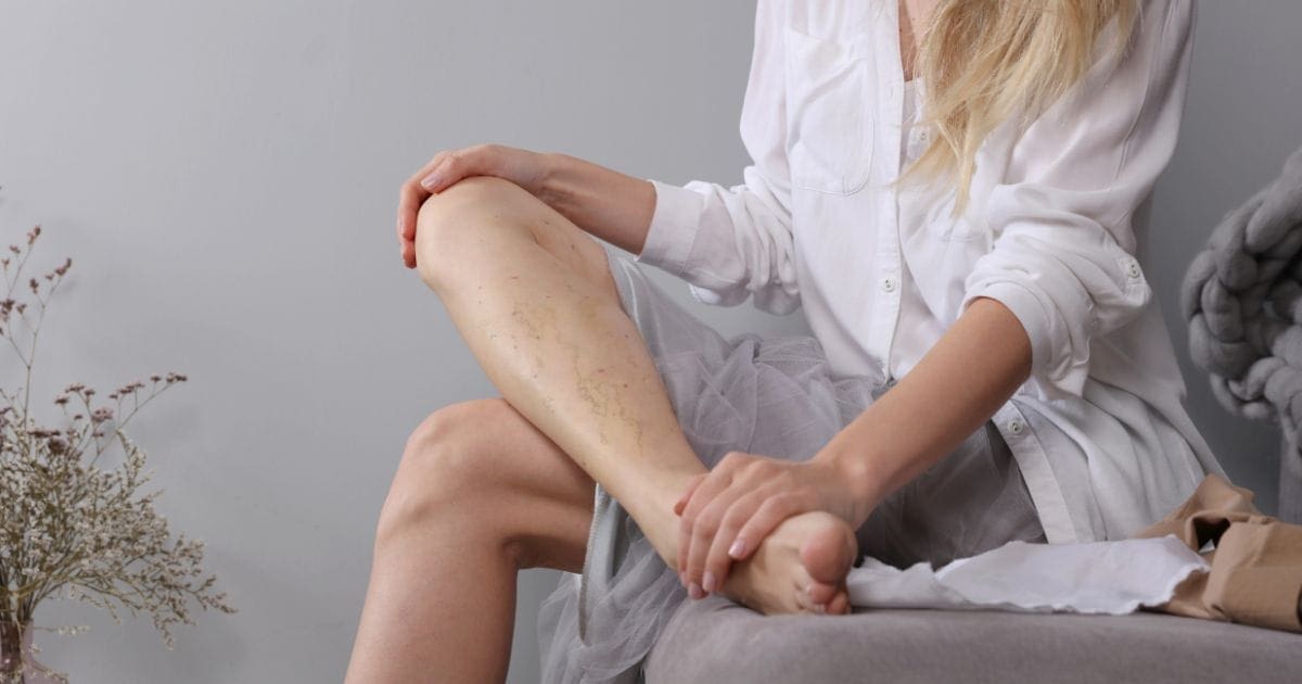 integratori per gambe gonfie